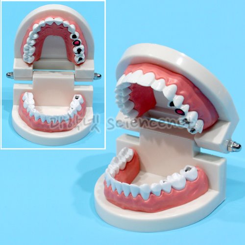 [유비네1257] 치아모형(충치형-소)