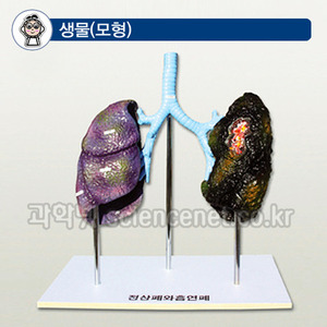 폐의비교(정상폐와흡연폐)